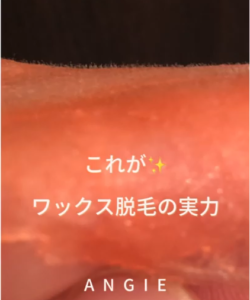これがワックス脱毛の実力です。お顔の産毛をとったワックスの拡大写真。